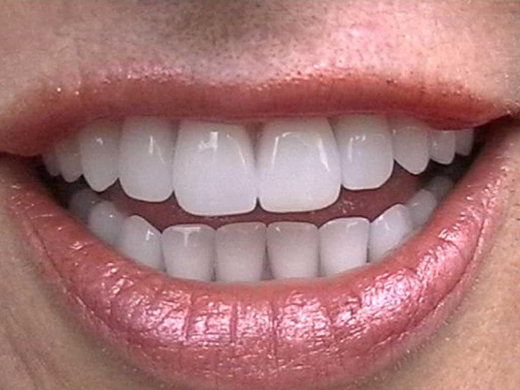 Total Diş(Dişsiz Ağızlarda Diş Estetiği)