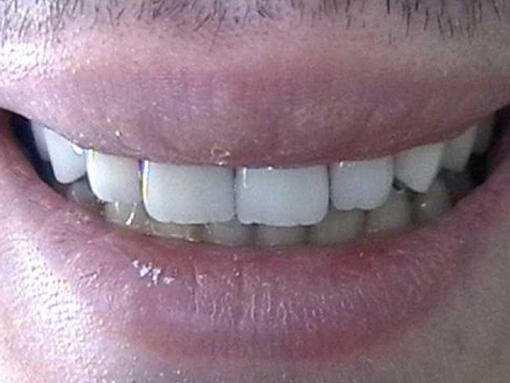 Aralık Diş ve Çapraşık Dişler